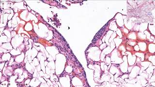 Peritoneal Carcinomatosis  Histopathology [upl. by Zetta]