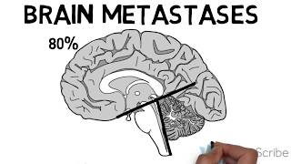 Brain Metastases [upl. by Hijoung506]